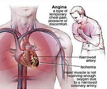 imagine cu angina pectoris